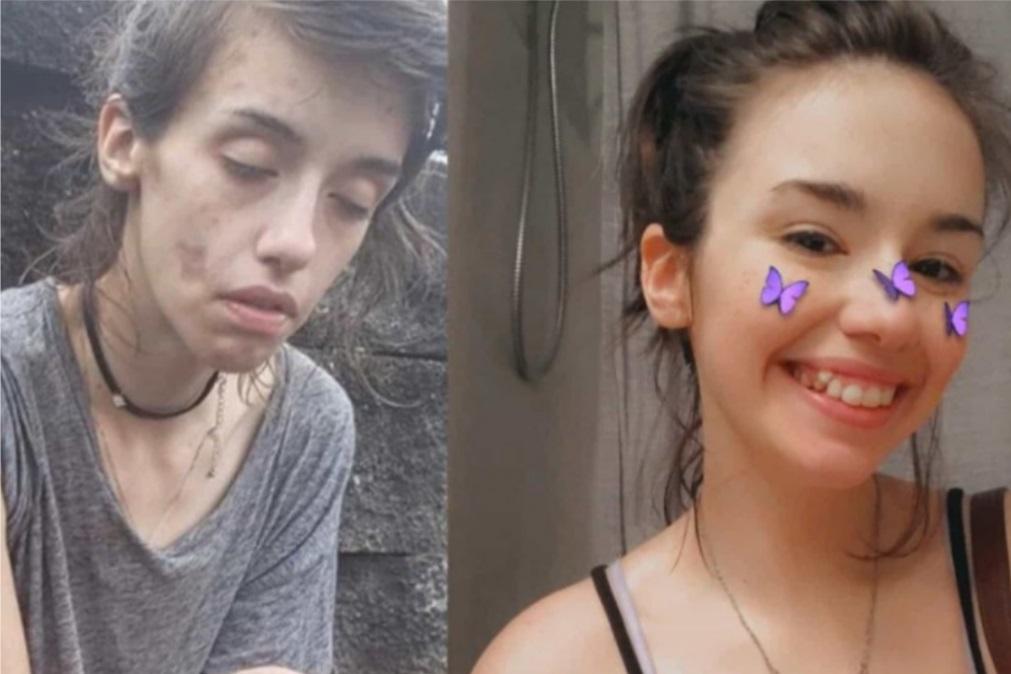 Jovem Viciada Em Drogas Revela Imagens Do Antes E Depois