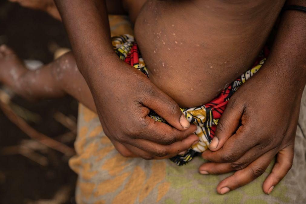 Mais de 22.800 casos e 622 mortes por mpox desde janeiro em 13 países africanos