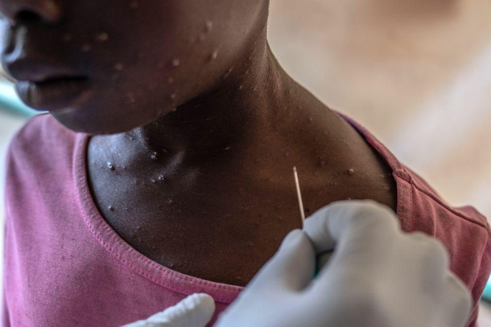 Mpox: Surto em Moçambique seria um desafio para um sistema de saúde já pressionado -- especialista