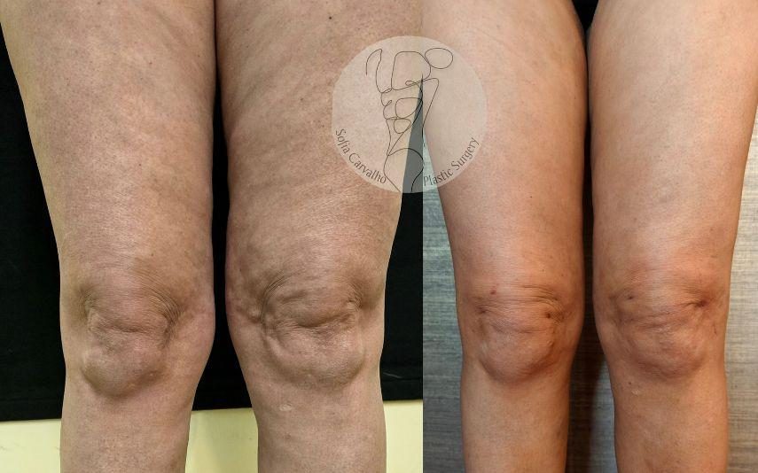 Lipedema - A doença que afecta quase 1 milhão de mulheres em Portugal!